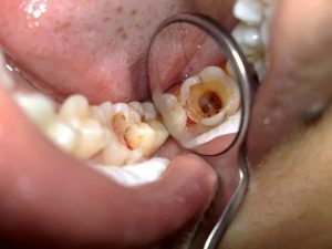 Dùng Xịt răng miệng - xịt trực tiếp vào chỗ răng đau