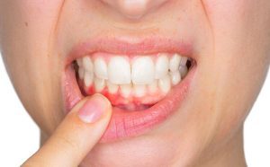 Do các mảng bám và cao răng chứa nhiều vị khuẩn gây tổn thương lợi và quanh răng